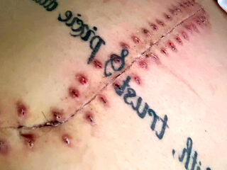 Scar Fetishes Stitches Staples Hospital Recovery After Surgery Teen Petite Small Waist